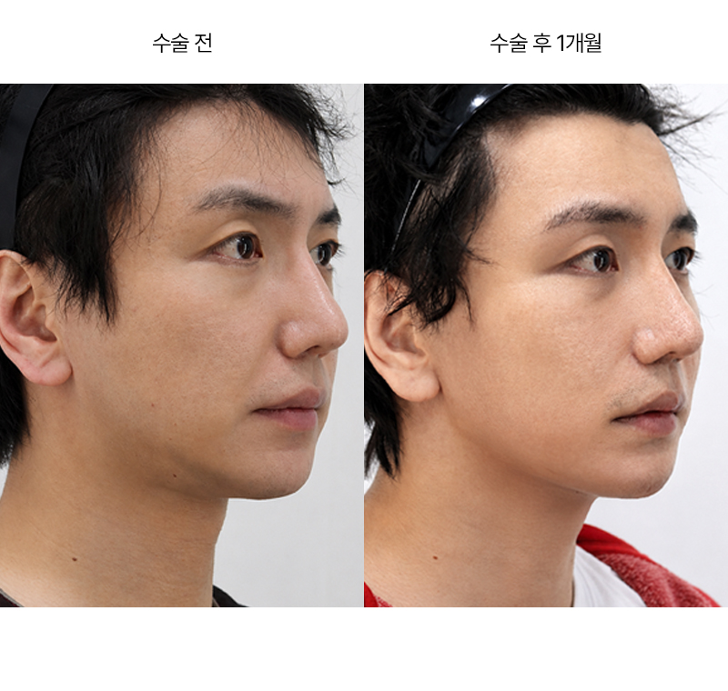 안면거상 · 압구정 팝성형외과 전후사진