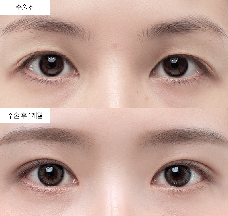 이마거상+12홀 자연유착 · 압구정 팝성형외과 전후사진