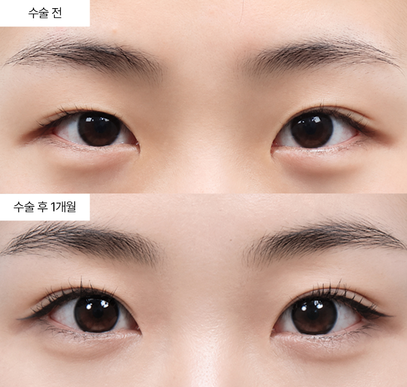 12홀 자연유착+윗트임+앞트임 · 압구정 팝성형외과 전후사진