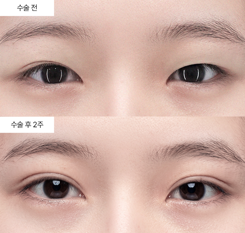 12홀 자연유착+눈매교정+윗트임