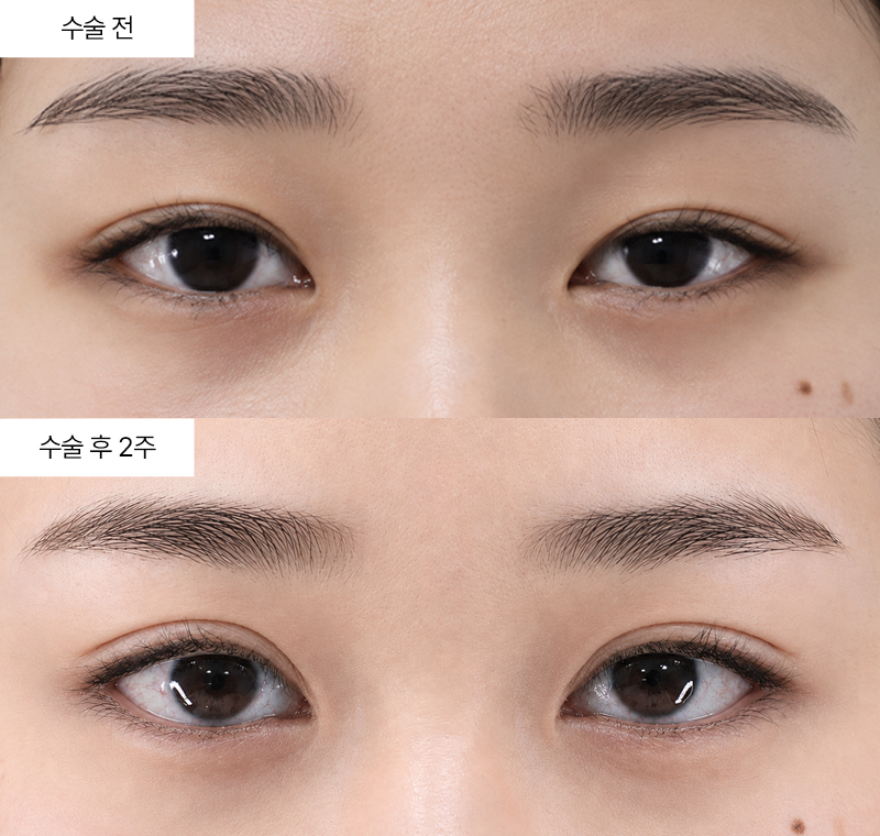 12홀 자연유착+눈매교정+앞트임