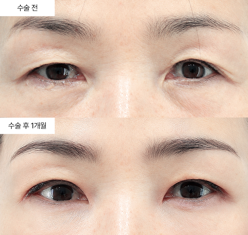 상안검+눈위지방재배치+하안검