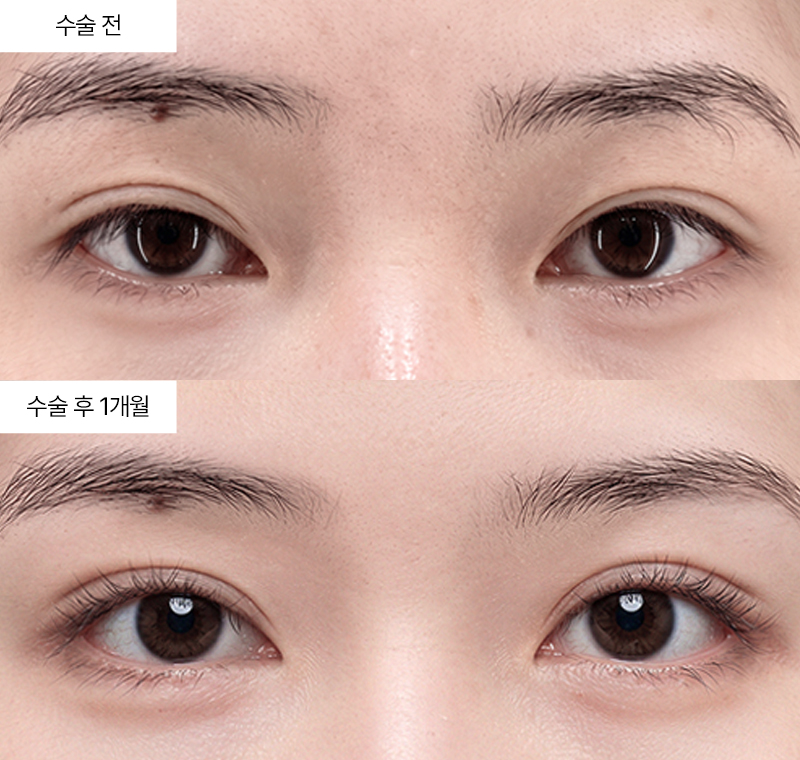 12홀 자연유착+뒤트임+밑트임