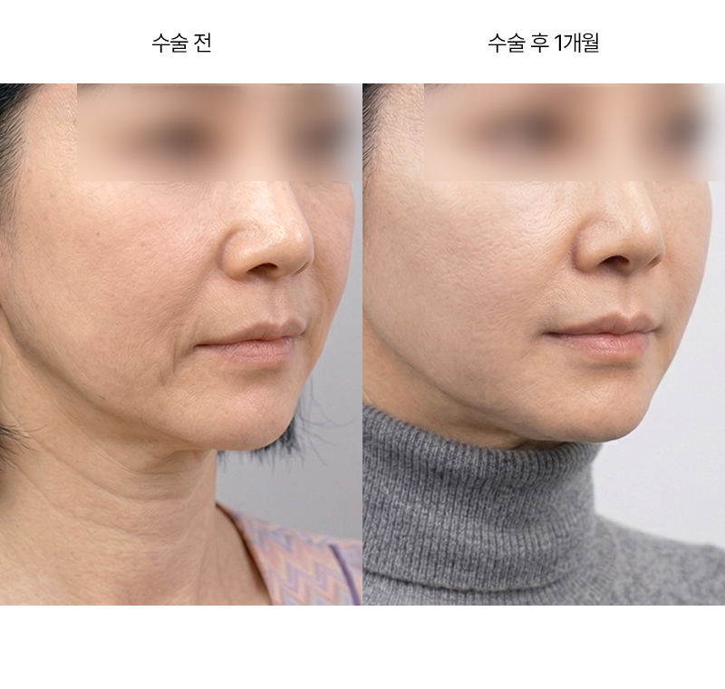 미니거상 · 압구정 팝성형외과 전후사진