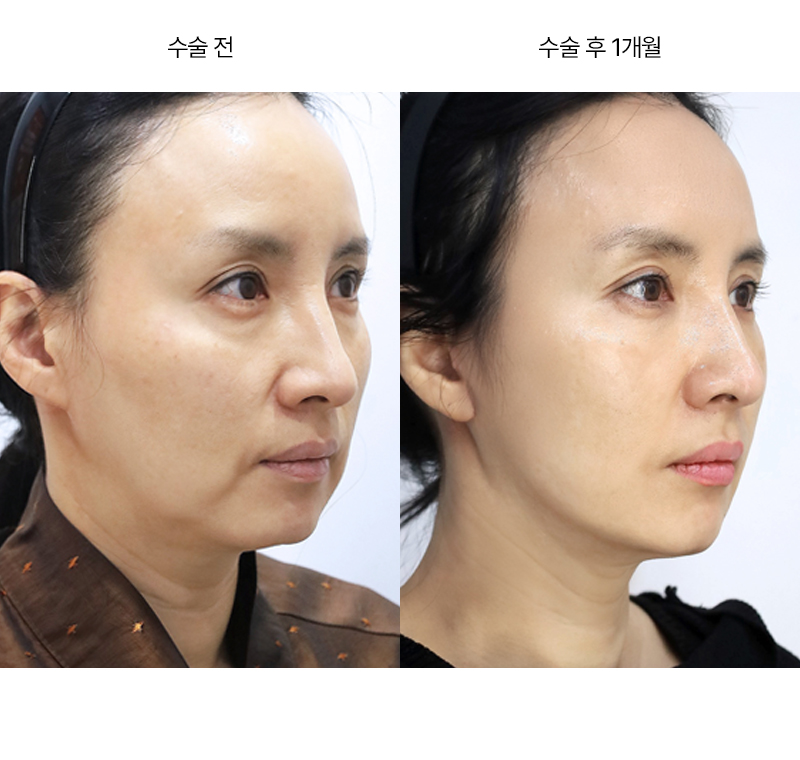 미니거상 · 압구정 팝성형외과 전후사진