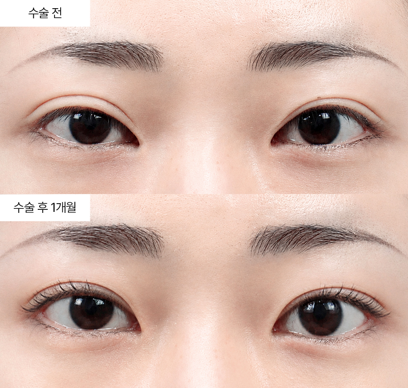 두줄따기+눈매교정+윗트임+뒤트임+밑트임 · 압구정 팝성형외과 전후사진