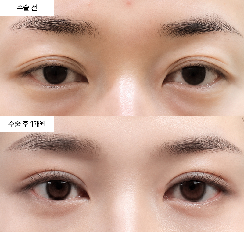 12홀 자연유착+눈매교정+윗트임 · 압구정 팝성형외과 전후사진