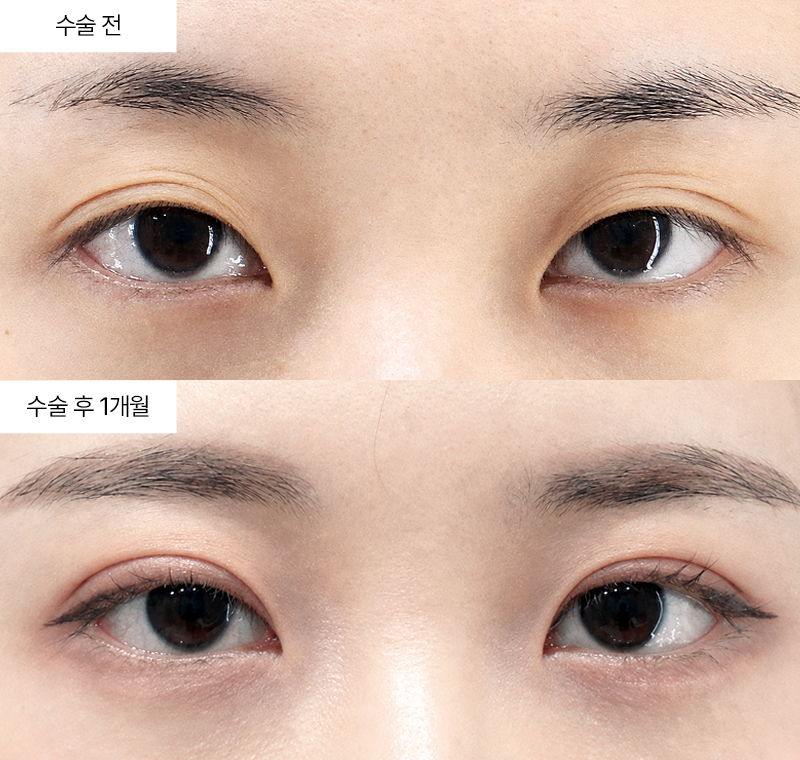 12홀 자연유착+눈매교정 · 압구정 팝성형외과 전후사진