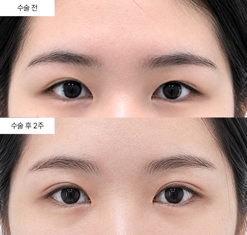 이마거상+12홀 자연유착