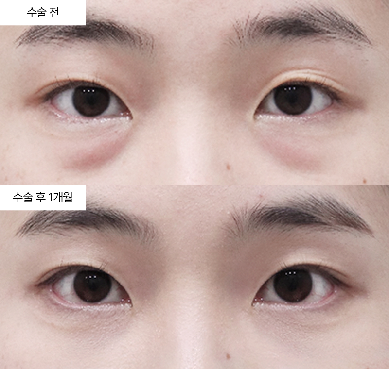 눈밑지방재배치