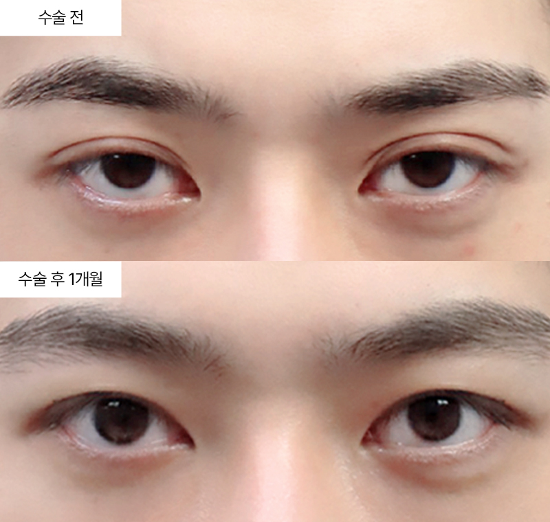 12홀자연유착+눈매교정