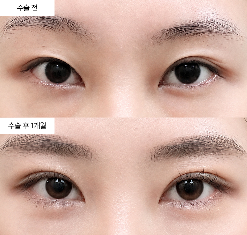 12홀 자연유착+윗트임 · 압구정 팝성형외과 전후사진