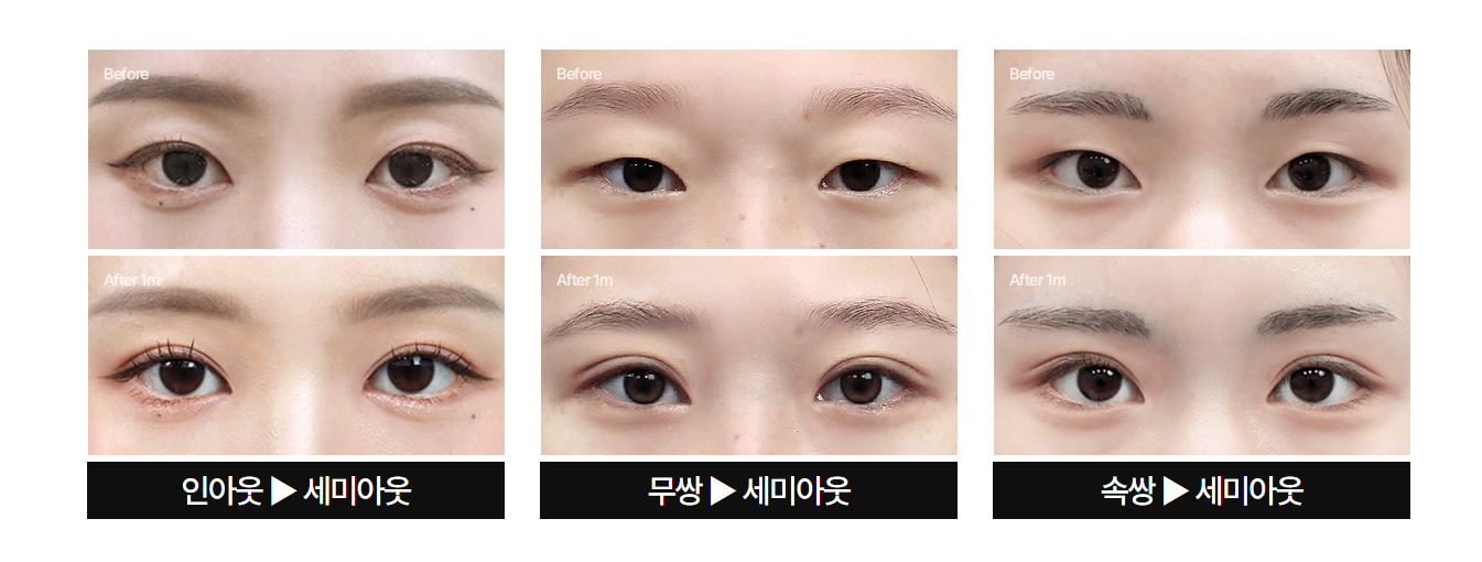 [눈 성형 전담센터] 세미아웃 쌍꺼풀, 자연스러우면서 또렷한 라인이 가능한 이유