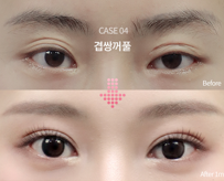[눈 성형 전담센터] 쌍꺼풀 재수술 꼭 해야 할까?