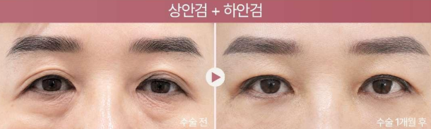 [눈 성형 전담 센터] 상안검과 하안검, 받으면 어떻게 달라질까요