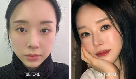 [눈 성형 전담센터] 쌍꺼풀 재수술, 언제 받아야 할까요