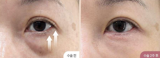 [눈 성형 전담센터] 눈밑지방재배치, 꼭 필요한 사람 따로 있어요