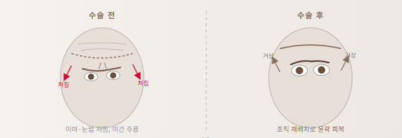 [리프팅 전담 센터] 이마가 무거워진다는 건, 시간이 내려앉는다는 말이에요 — 이마거상 수술 전에 알아야 할 것들