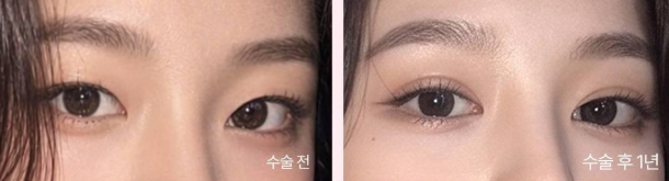 쌍꺼풀 수술이란? 비절개·절개 차이부터 회복기간까지