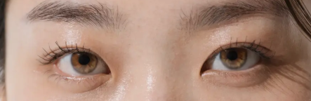 [눈 성형 전담센터] 눈매교정이란? 졸려 보이는 눈, 수술로 달라질 수 있어요