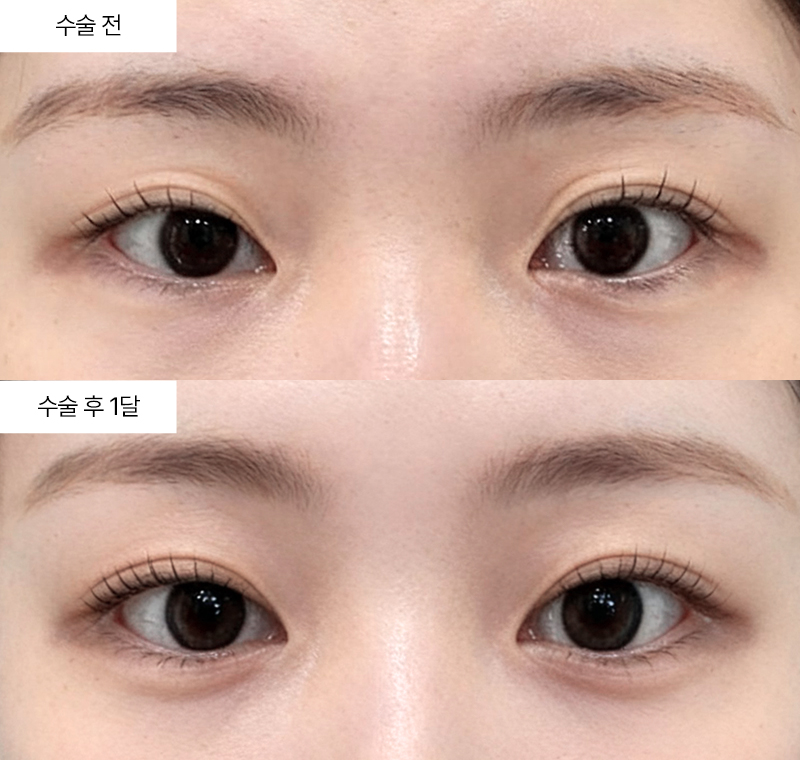 [눈 성형 전담센터] 쌍꺼풀 재수술, 처음 수술과 무엇이 다를까요?