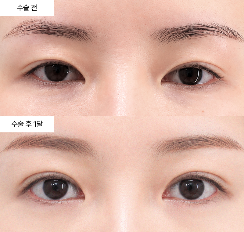 눈꺼풀 처짐 교정, 나에게 맞는 방법은 무엇일까요