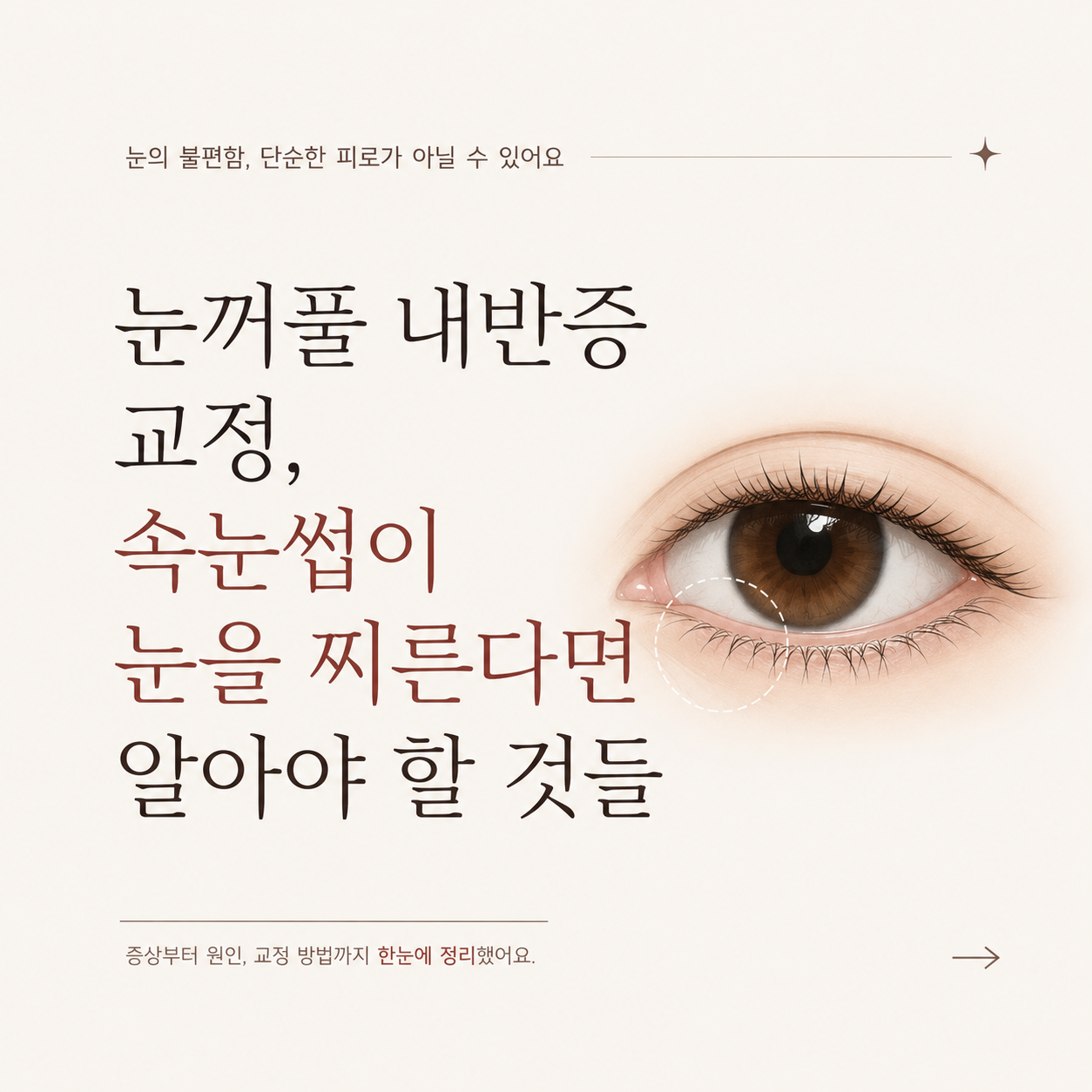 눈꺼풀 내반증 교정, 속눈썹이 눈을 찌른다면 알아야 할 것들