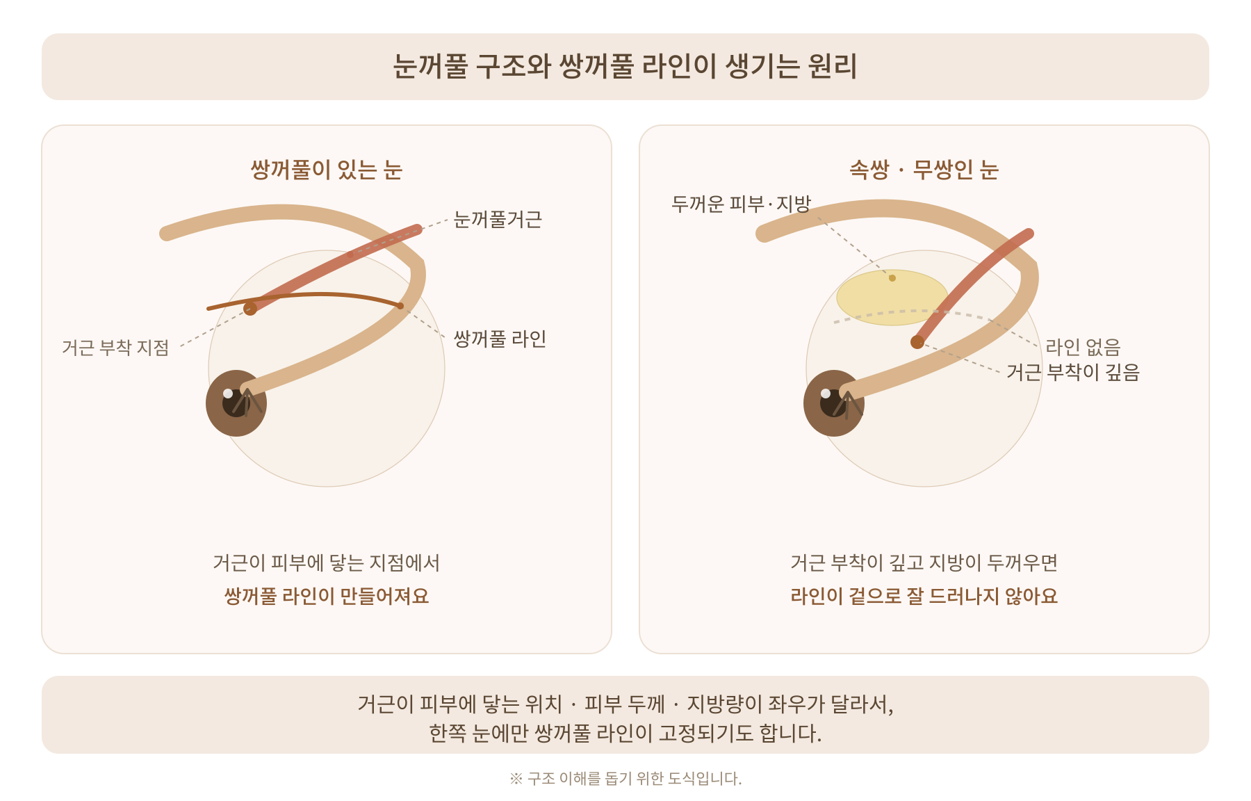 쌍꺼풀 없는 눈이 인아웃으로 달라지는 이유