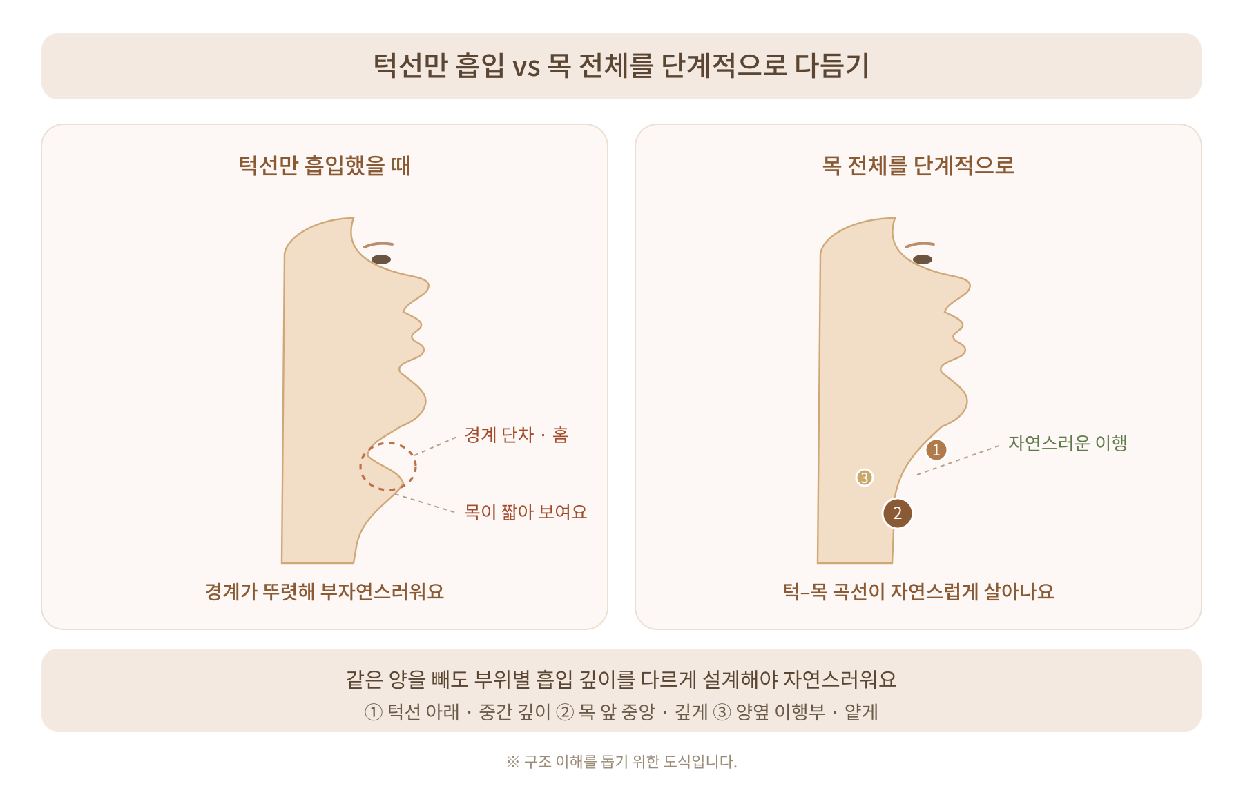 이중턱지방흡입 자연스러운 턱선 만들기