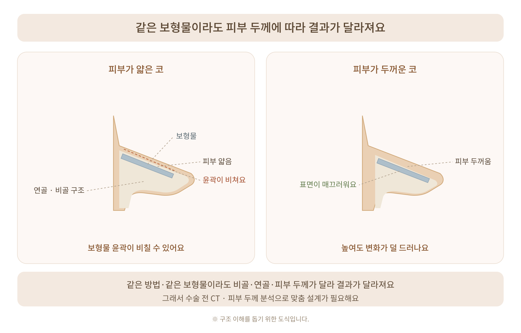 코성형, 왜 같은 수술인데 결과는 다를까요?