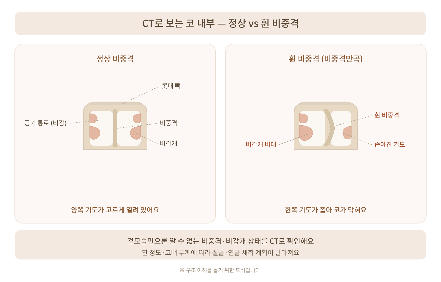 코성형