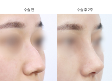 코성형, 내게 맞는 수술일까? 적합한 대상 기준