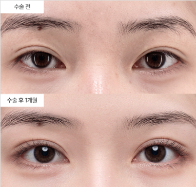 쌍꺼풀 수술, 절개와 매몰 중 어떤 방법이 나에게 맞을까요?