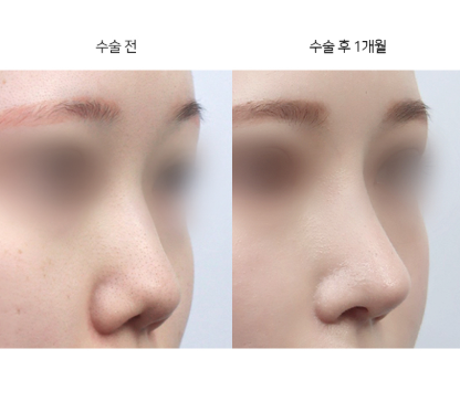 코성형, 왜 10년 뒤를 먼저 보고 결정해야 할까?