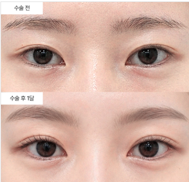 쌍꺼풀, 누구에게 맞고 누구에게 맞지 않을까