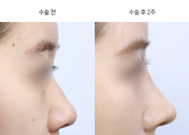 코성형, 실리콘과 자가연골 중 뭘 선택해야 할까요?