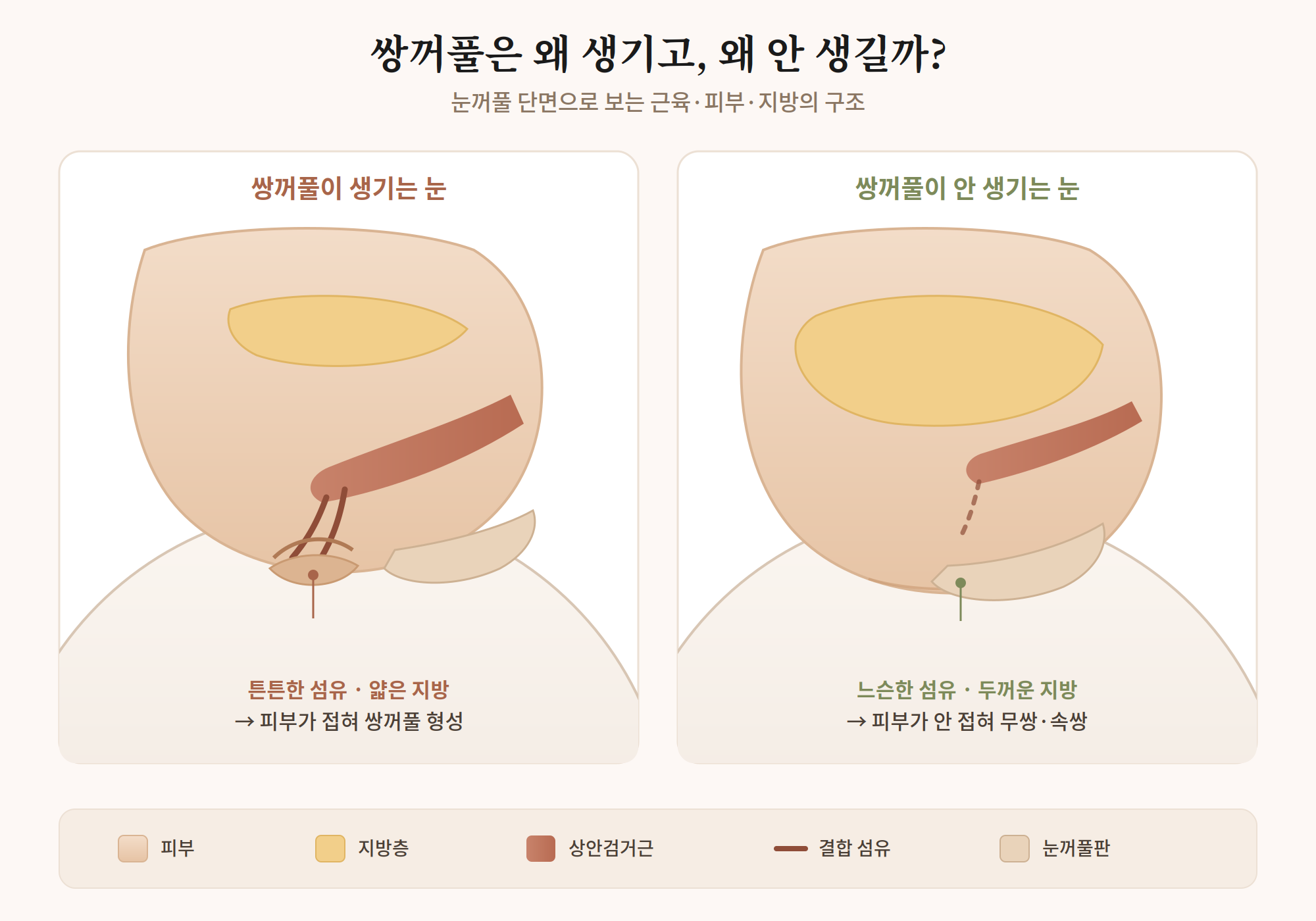 쌍꺼풀 수술, 절개와 매몰 중 뭐가 나한테 맞을까요?