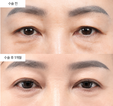 하안검 수술, 언제 받는 게 가장 효과적일까요?