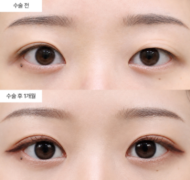 쌍꺼풀이 자꾸 풀리는 이유가 뭘까요?