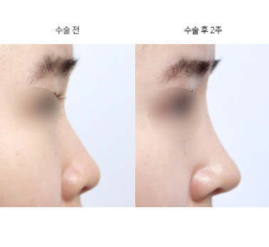 코성형 실제 완성까지 얼마나 걸리나요?