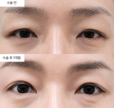 눈성형 결과가 나이 들면서 처지는 게 맞는 말인가요?