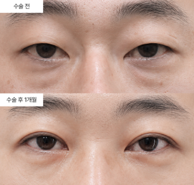 눈밑지방재배치 후 눈물고랑이 생기는 이유는 뭔가요?