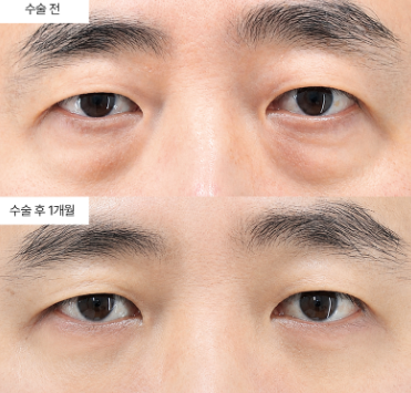 하안검 재수술, 언제 고려해야 할까요?