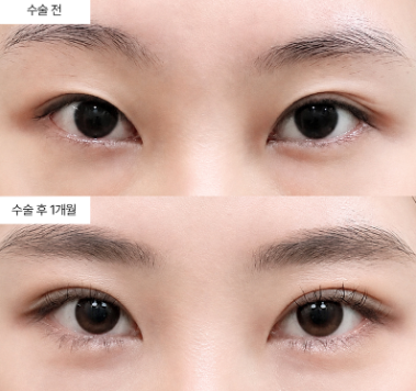 눈재수술 라인을 올릴지 내릴지, 어떻게 정하나요?