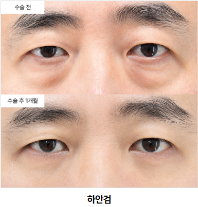 하안검 재수술, 언제 고려해야 할까요?
