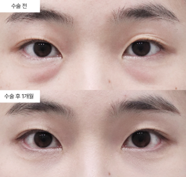 눈밑지방재배치가 왜 필요한지 알고 싶다면