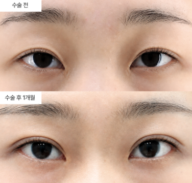 안검하수 수술, 언제 받는 게 좋을까요?