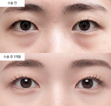 눈밑지방재배치, 가장 좋은 시기가 언제일까요?