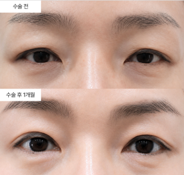 40대인데 상안검 수술 지금 받아도 괜찮을까요?