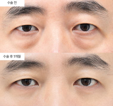 하안검 재수술, 언제 고려해야 할까요?